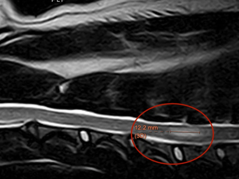 Resonancia magnética de columna de un paciente neurológico de Lomont®, con la lesión medular señalada y medida por el especialista para planear el tratamiento